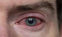 Advancements in Corneal Wound Healing